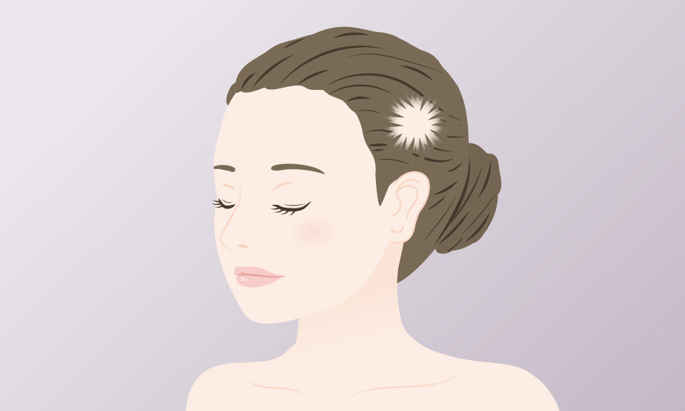 3. 硬貨くらいの大きさの脱毛がある